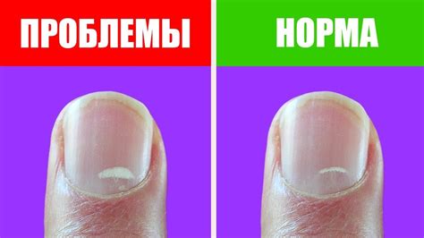 Полоски и белые пятна на ногтях: что это говорит о вашем здоровье ...