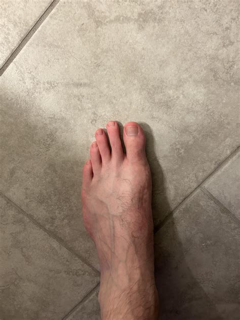 Bunions: Treatment, causes, non-surgical and surgical approaches