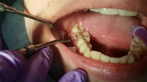 Cavity Before And After Filling