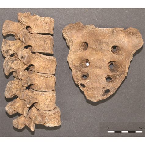 Sacral spina bifida (S1–S5) occulta in a male (Case no. 190 ...