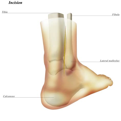 Lateral Malleolus