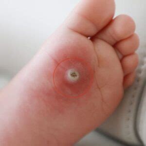 Ojo de pescado en el pie ¿Cómo surge y cómo quitarlo | Raza Folklorica!