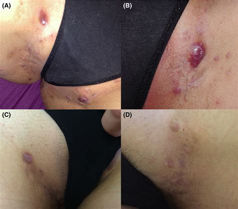 Hidradenitis Suppurativa Thigh Treatment