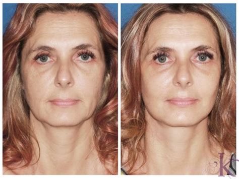 Mini Facelift in Manhattan, NYC | Konstantin Vasyukevich, MD