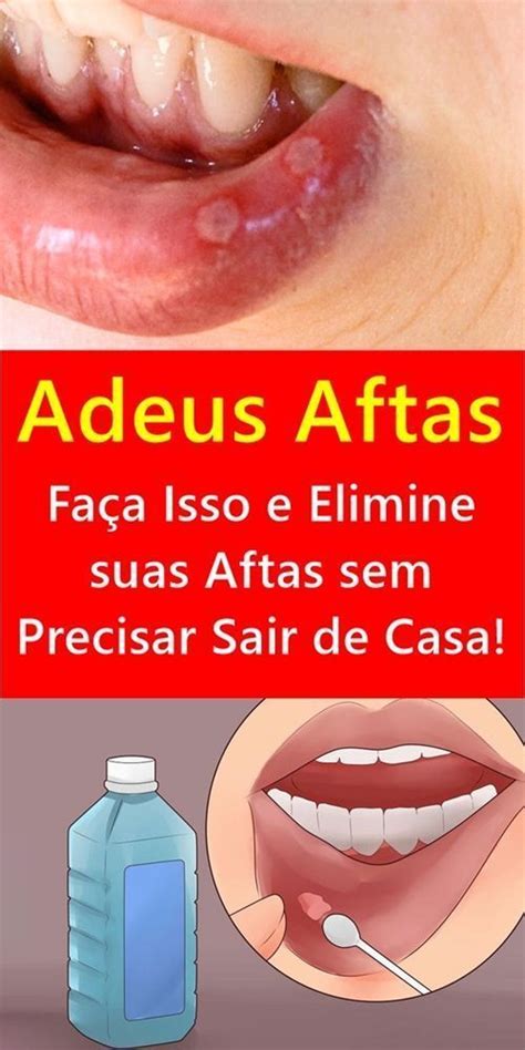 Como Curar Afta Em Casa - Adeus Aftas - Faça Isso e Elimine suas Aftas sem Precisar Sair de Casa ...