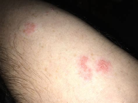 Red Spots Rash On Upper Arm at Eldridge Rucker blog
