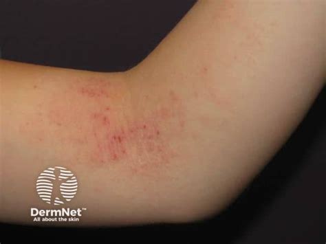 Atopic flexural eczema images