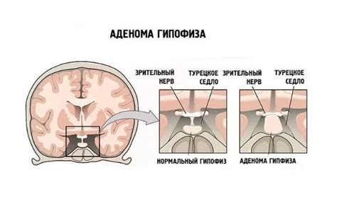 Лечение аденомы гипофиза в Днепре – операция по удалению аденомы ...