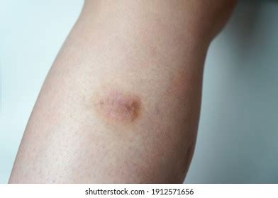 Close-up Cyanotic Scar Scar On Leg Stock Photo 1912571656 | Shutterstock