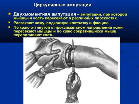 Ампутация конечности и протезирование - презентация онлайн