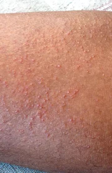 Prakaitinis bėrimas - Dermatologo konsultacija internetu
