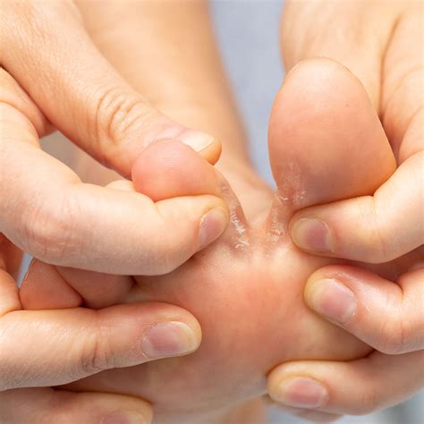 Treating Nail Fungus