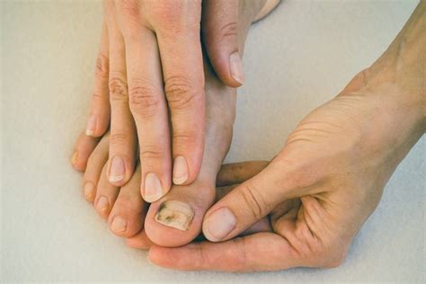 toenail fungus | Black toenail fungus, Nail fungus, Toenail fungus ...