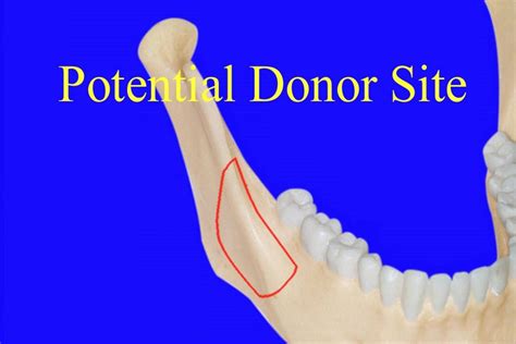 ramus block graft stuart orton jones