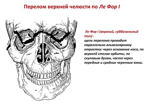 Перелом верхней челюсти. Классификация, клиника, диагностика. Лечение ...