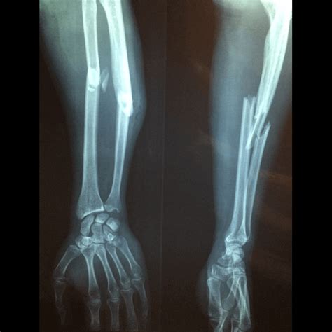 fractures worsley training