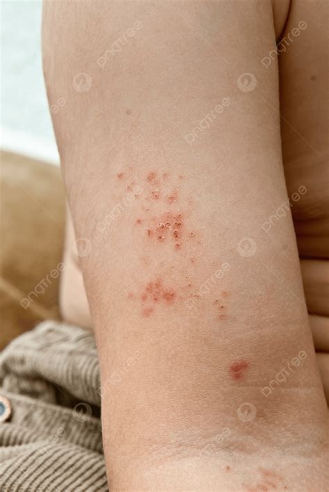 Arm Sores
