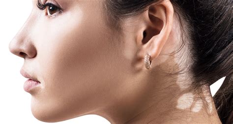 Vitiligo: Was ist das? Ursachen & Behandlung | kanyo®