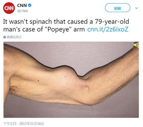 popeye deformity symptoms biceps tendon rupture pgkiv