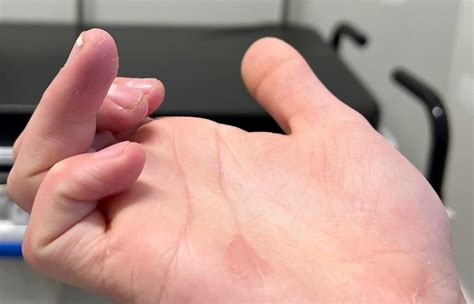 OrthoDx: Jersey Finger - Clinical Advisor