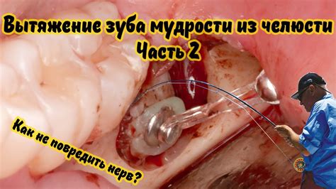 Вытягиваем зуб мудрости для последующего удаления без травмы для нерва ...