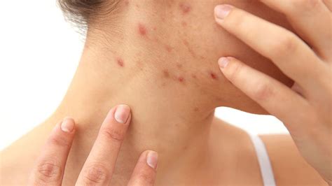 Akne » Häufigkeit, Ursachen, Diagnose & Therapie | MeinMed.at