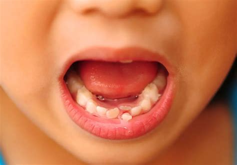 save loose teeth  falling  stabilization tips