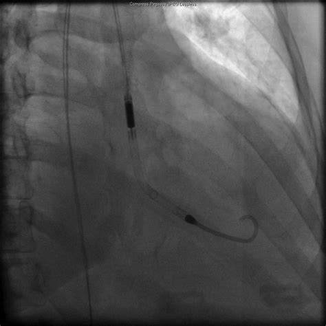 Use of the Impella 2.5 left ventricular assist device in a patient with