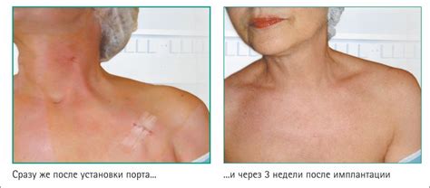 какие бывают порт системы для химиотерапии