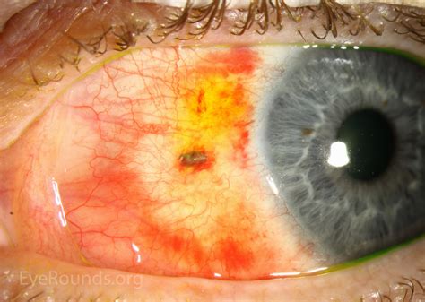 Atlas Entry - Subconjunctival metallic foreign body