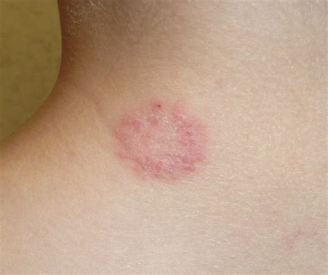 An Itchy, Round Rash on the Back of an Adolescent’s Neck | Consultant360