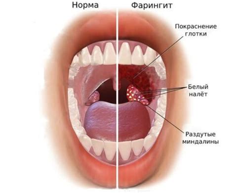 Всё что нужно знать о фарингите и его лечении | Liqmed.ru