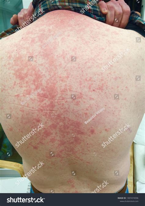 skin rash   man stock photo  shutterstock