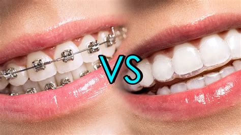 braces  clear aligners      archwired