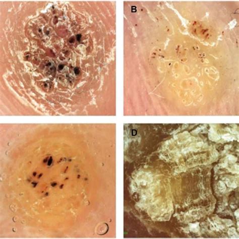 Different patterns of plantar warts under the dermoscope. (A) frogspawn ...