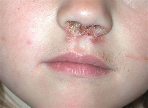 Impetigo: What to Know About This Common Skin Infection in Children ...