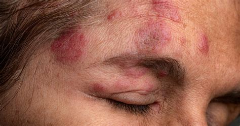 ocular shingles     treated nebraska medicine