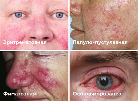 Горящие красные щеки и сосуды на лице. В чём разница между куперозом и ...