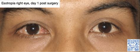 strabismus surgery roque eye clinic eyecomph