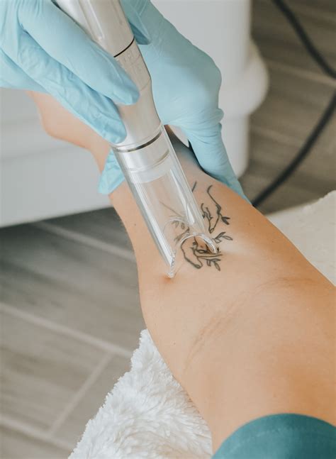 lasers tattoo 1