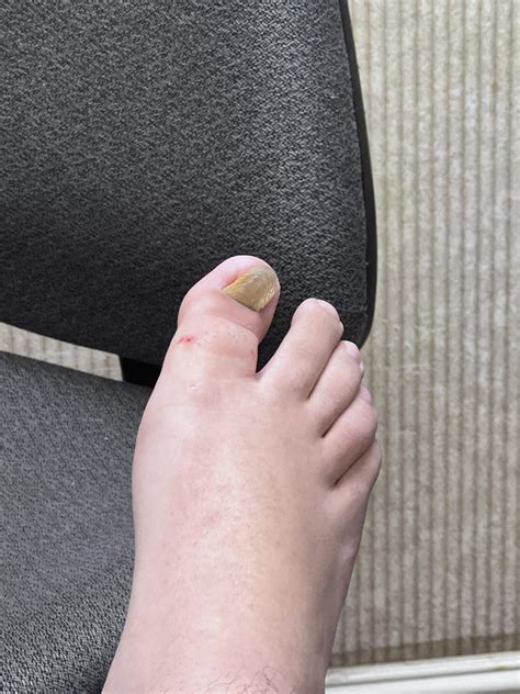 Got one of my ingrown nails removed : r/Ingrown_Toenails
