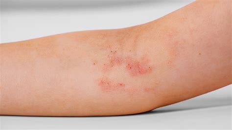 Psoriasis vs. Eczema: Images and Key Differences - GoodRx