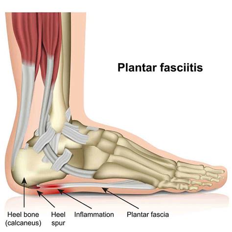 Heel Pain (Plantar Fasciitis): Causes, Treatments, and Prevention ...