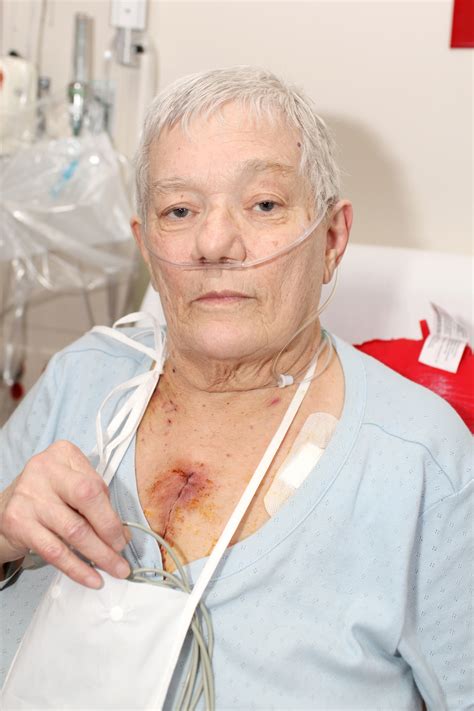 Chest Tube Management After Coronary Artery Bypass Graft - Nursing CE