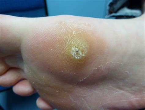 Plantar Wart Foot Bottom Diagram