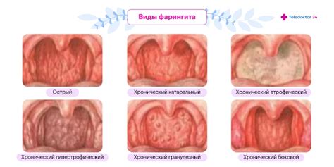 Фарингит - симптомы у взрослых и детей, что такое острый и хронический ...