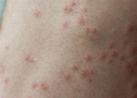 Itchy Bug Bite Rash