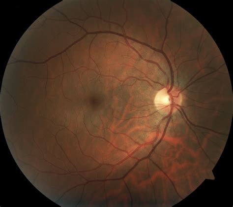 retinal  optical coherence tomography imaging
