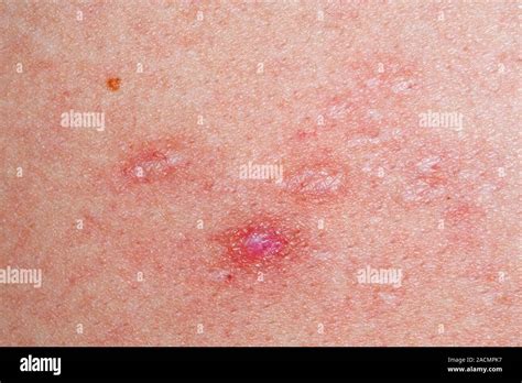 Close-up of scars caused by previous shingles on the skin of the back ...