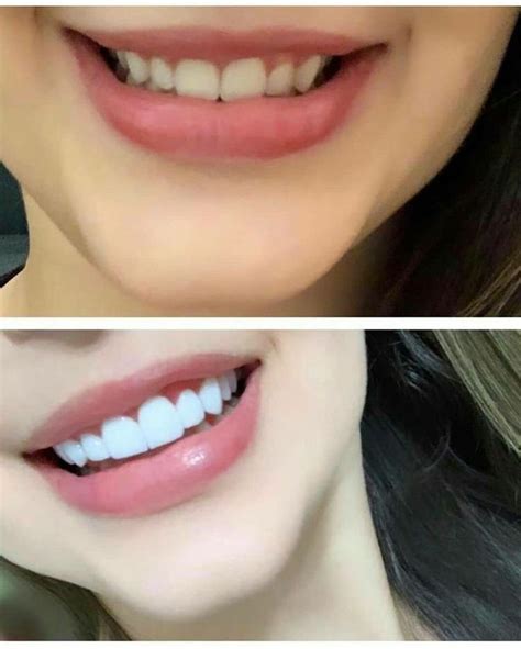 healthy beautiful teeth pretty teeth beautiful teeth perfect teeth